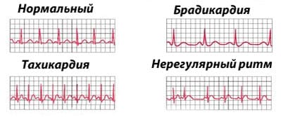 Перебои в работе сердца Перебои в работе сердца
