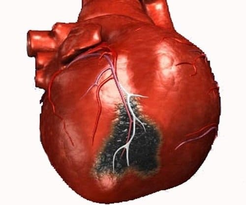 Первые признаки инфаркта миокарда