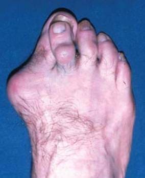 Hallux valgus – выраженная стадия плоскостопия