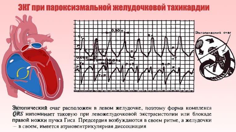 Учащенное сердцебиение Учащенное сердцебиение