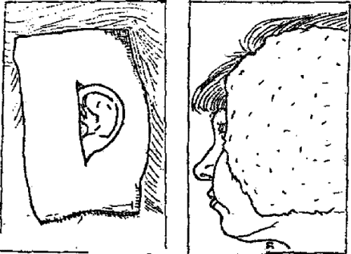 Компресс на ухо при отите Компресс на ухо при отите