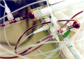 Плазмаферез (очищение плазмы крови)