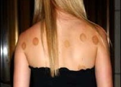 Синяки после вакуумного массажа