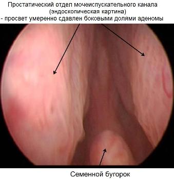 Эндоскопическая картина аденомы простаты Эндоскопическая картина аденомы простаты