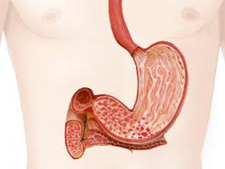 Локализация воспаления при гастродуодените