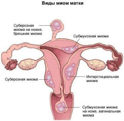 Миома матки и беременность