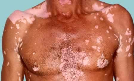 Симптомы витилиго светлые пятна на коже