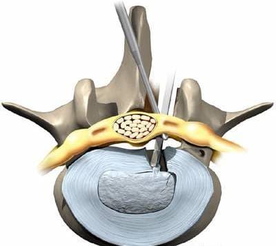 Чрезкожная заднебоковая фораменоскопия Чрезкожная заднебоковая фораменоскопия