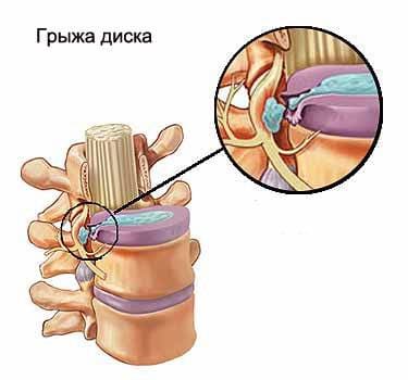 Грыжа диска Грыжа диска