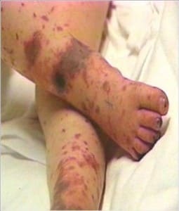 http://www.medicalj.ru/images/stories/bolezni/nevrologiya/meningit2.jpg