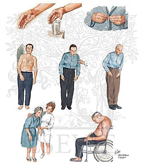 Симптомы болезни Паркинсона и паркинсонизма Симптомы болезни Паркинсона и паркинсонизма